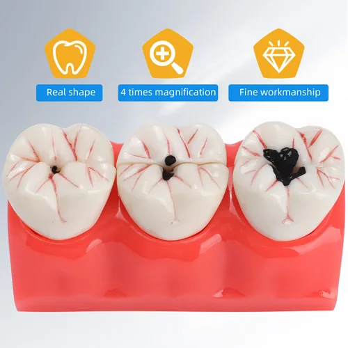 Vista 4 de Modelo de dientes de caries dentales - Modelo de caries dental extraíble 4 veces modelo de caries dental modelo de evolución de caries dental