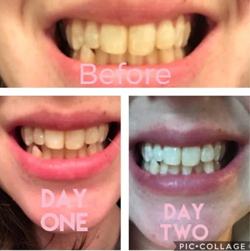 Vista 2 de Recarga de gel blanqueador dental 4X jeringas 44% peróxido de carbamida