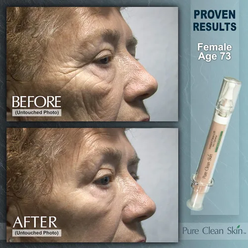 Vista 5 de EUZEN - Crema para apretar la piel para la cara – Obtén un estiramiento facial instantáneo en 3 a 5 minutos – esta crema antiarrugas para ojos