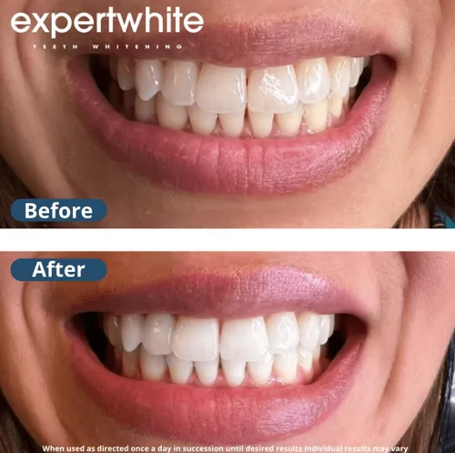 Vista 6 de Gel blanqueador dental extremo 44% (6 geles)