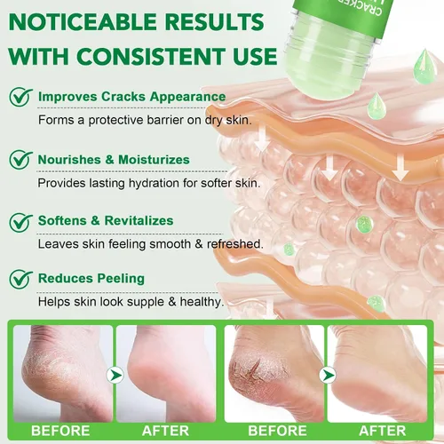 Vista 7 de Crema de urea removedor de callos para pies, 60% de urea con 2% de ácido salicílico, hidratante de fuerza profesional para pies agrietados secos