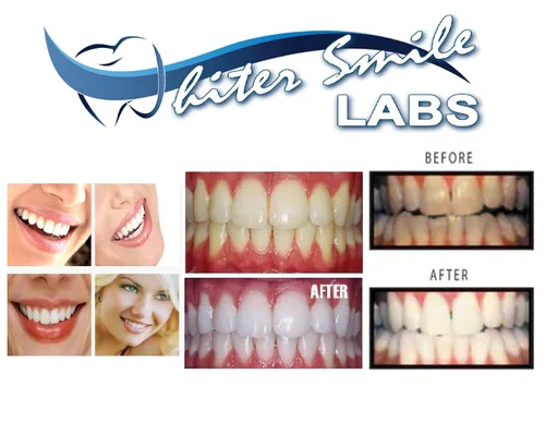 Vista 2 de Kit profesional de bandeja blanqueadora de dientes personalizada. Bandeja de blanqueamiento dental directa de laboratorio dental, bandejas