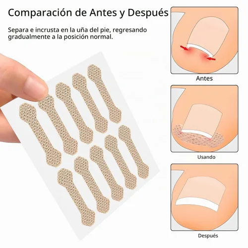 Vista 6 de Tratamiento de uñas encarnadas, 100 tiras transpirables de uñas encarnadas, herramienta de uñas encarnadas sin dolor, pedicura profesional