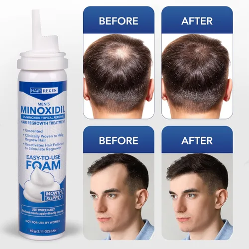 Vista 4 de Hair Regen Minoxidil Foam para hombres 5% - Tratamiento de crecimiento del cabello para hombres para él - Espuma tópica Minoxidil para hombres
