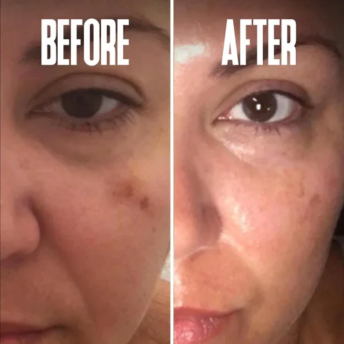 Vista 8 de Eliminador corrector de puntos oscuros de hidroquinona 2% para el tratamiento facial y melasma, contiene vitamina C, ácido salicílico, ácido kójico