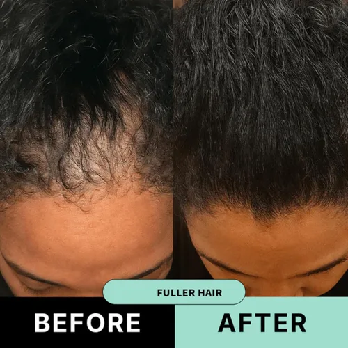 Vista 11 de Kit de renovación de cabello con micro infusión, suero para el cabello con ácido hialurónico, péptido y ampollas de suero botánico