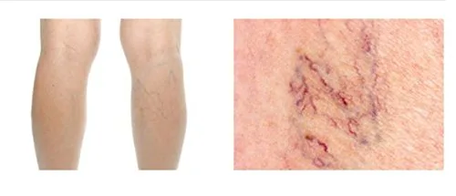Vista 2 de Vitella Vein VIT Benemedo - Araña, venas varicosas - Desarrollado con dermatólogos - 1.7 fl oz
