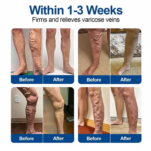 Vista 2 de Vein Ease Microdarts Care Patch, tratamiento profesional de venas varicosas para piernas, parche GFOUK Vein Ease, alivia la circulación sanguínea