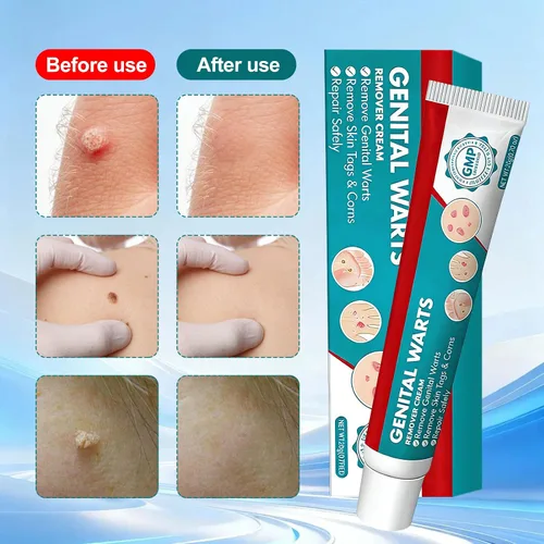 Vista 3 de Crema eliminadora de verrugas, crema para verrugas genitales, verrugas, verrugas plantares, verrugas comunes, maíz, Flat Wars NDC (84010-200-01)