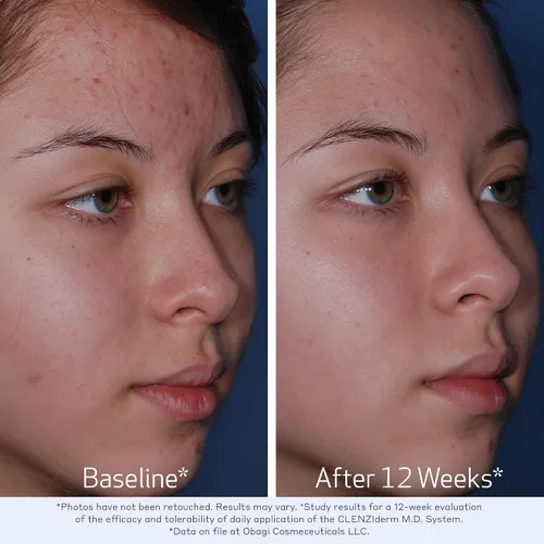 Vista 3 de Obagi CLENZIderm M.D. Tónico exfoliante BHA para terapia de poros, desobstruye los poros con tratamiento del acné con ácido salicílico al 2%, 5 onzas