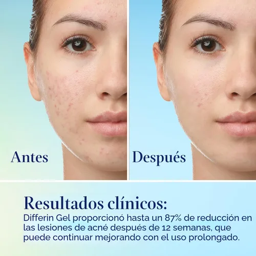 Vista 11 de Kit de cuidado de la piel para acné Differin, tratamiento de acné con retinoide Differin Gel para la cara con 0.1% de adapalene y 5% de peróxido