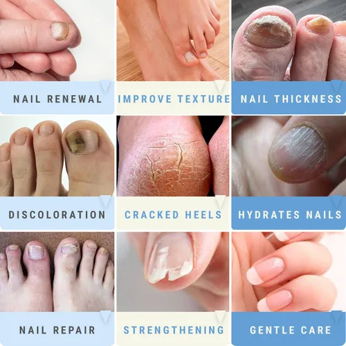 Vista 4 de Urea 50% Gel de uñas – Suaviza los callos agrietados del talón y las uñas gruesas de los pies – Repara uñas dañadas, amarillas y decoloradas