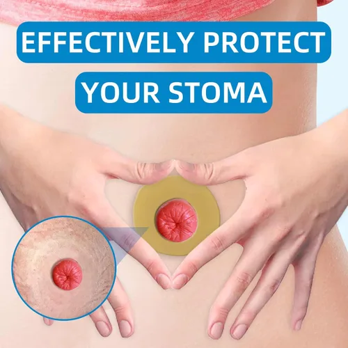 Vista 4 de Anillos de barrera para ostomía, anillos de ostomía moldeables sin picaduras, anillos extensores de piel hidrocoloides para bolsas de colostomía