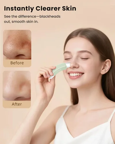 Vista 3 de Boloye Herramienta Eliminadora de Puntos Negros – Rascador Facial de Doble Cabezal y Limpiador de Poros para Limpieza Facial Profunda, Rascador