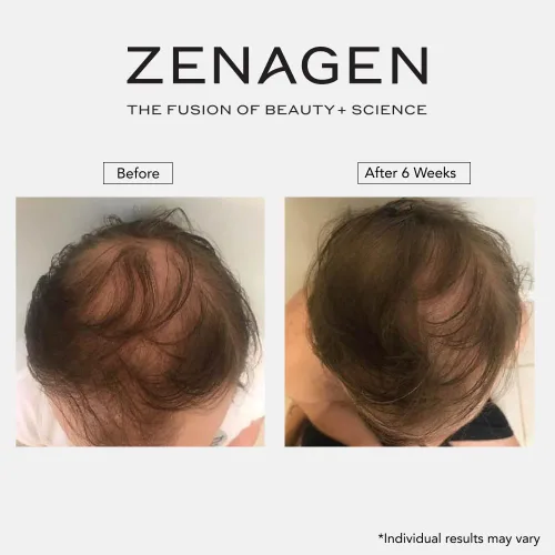 Vista 12 de Zenagen Revolve - Tratamiento de pérdida de cabello para hombres