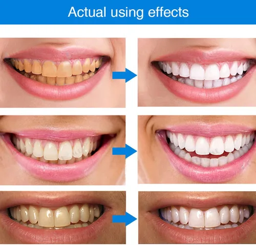 Vista 3 de 3 bolígrafos blanqueadores de dientes, esencia blanqueadora de dientes, gel blanqueador de dientes, removedor de manchas de dientes para blanquear