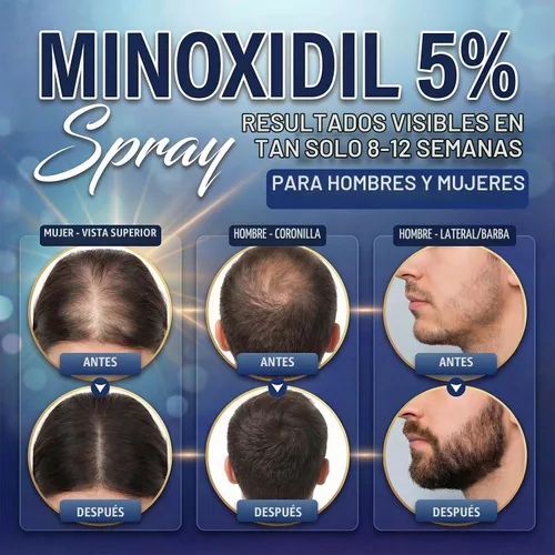 Vista 2 de Minoxidil 5% para hombres (4.1 fl oz), spray avanzado de minoxidil con provitamina B5 y extracto de semilla de ricino, suero de extracto