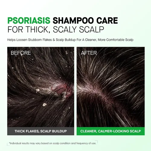 Vista 5 de Roycederm Champú para la psoriasis, tratamiento medicado para el cuero