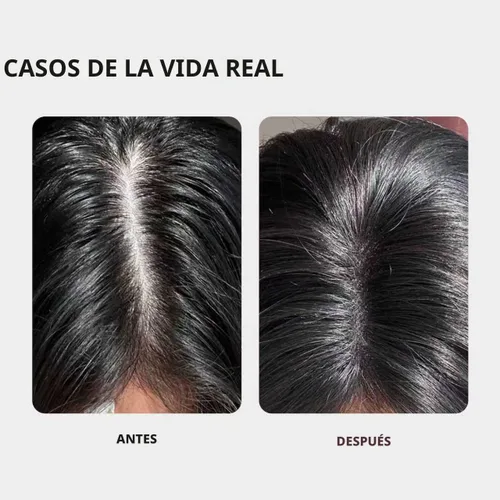 Vista 3 de KINTOR 0.5% KX-826 DHT Bloqueador de Vello Spray para Hombres y Mujeres 2 fl oz