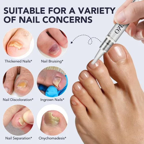 Vista 9 de Pluma de hongos en las uñas de los pies, tratamiento de uñas extra fuerte, 25% ácido undecilénico, aceite de árbol de té, bolígrafo de reparación