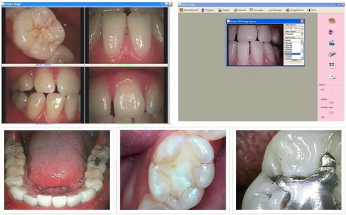 Vista 3 de FocusDent Cámara intraoral dental MD740 - Fácil conexión USB, 6 LED, 1.3 megapíxeles - Software dental incluido!