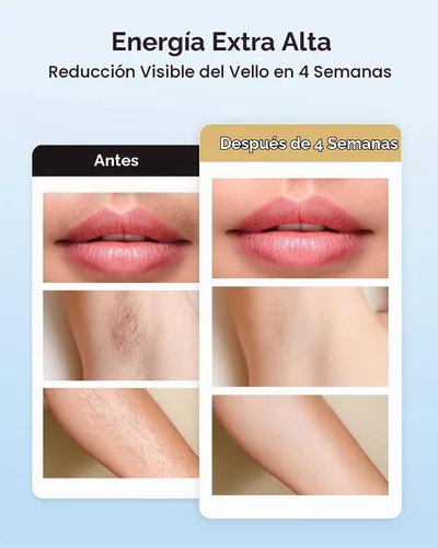 Vista 3 de Dispositivo de depilación de uso doméstico IPL