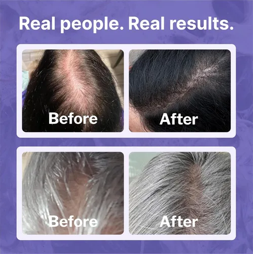 Vista 4 de Shapiro MD Hair Growth Experts Minoxidil Solución tópica al 2% para mujeres, el suero promueve el recrecimiento del cabello al reactivar