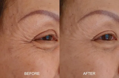 Vista 3 de Magic Serum-No Needle Alternative-BioActive Argireline Peptides Complex Anti-Eexpression Line/Creases Serum-Matrixyl 3000, SNAP-8, Pentapeptide-18