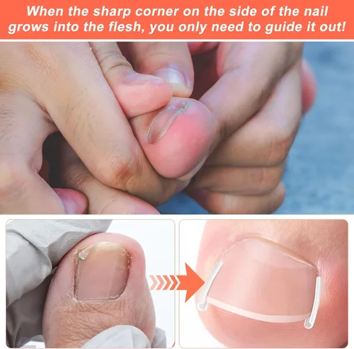 Vista 4 de (50+2) Juego de corrector de uñas encarnadas con cortaúñas, kit profesional de eliminación de uñas encarnadas sin dolor con levantador, tira de uñas