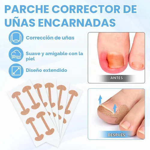 Vista 3 de Kit de eliminación de uñas encarnadas con tiras de uñas encarnadas, parche corrector de uñas curvas, lima de uñas y herramientas de pedicura