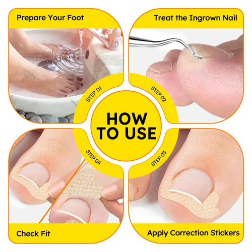 Vista 4 de Tratamiento de uñas encarnadas, corrector de uñas curvadas transpirables, tiras correctoras de uñas encarnadas con lima y levantador, kit
