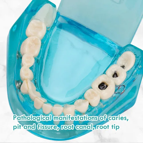 Vista 6 de Modelo de dientes de implante dental transparente - Modelo de dientes de enfermedad transparente Modelo de dientes patológicos con dientes