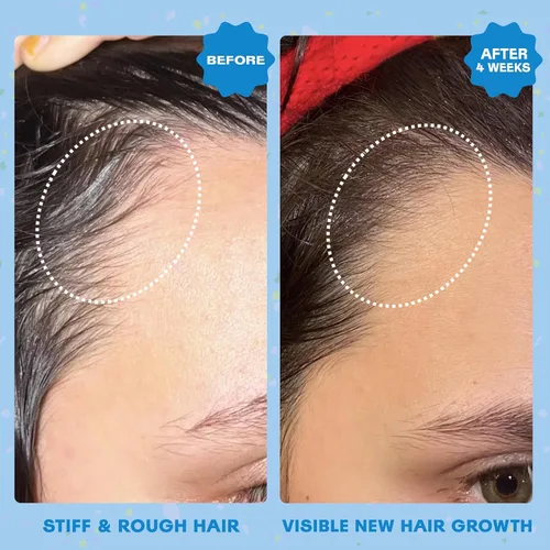 Vista 3 de Squigs Aceite para el crecimiento del cabello para cabello seco y dañado, con mezcla de aceite de amla, ricino y coco para control