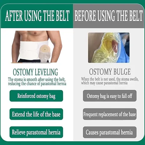 Vista 6 de Cinturón de soporte para ostomía, ajustable para prevenir hernia parastomal para hombres y mujeres Cinturón de soporte abdominal postoperatorio
