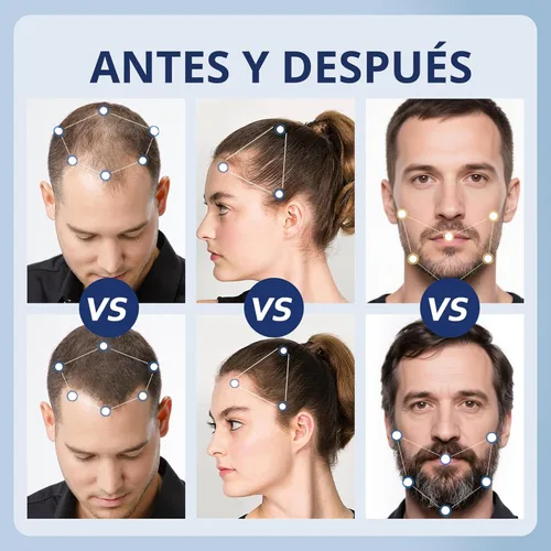 Vista 4 de Suero para el crecimiento del cabello de minoxidil al 5% para hombres y mujeres con biotina: minoxidil para hombres y mujeres, 5 por ciento