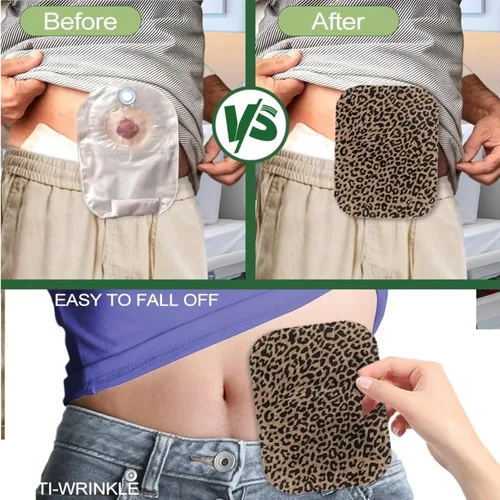 Vista 5 de Rnyleeg Fundas de bolsa de colostomía con estampado de leopardo para mujer, suministros de ostomía de moda de 4 piezas para ileostomía, cuidado