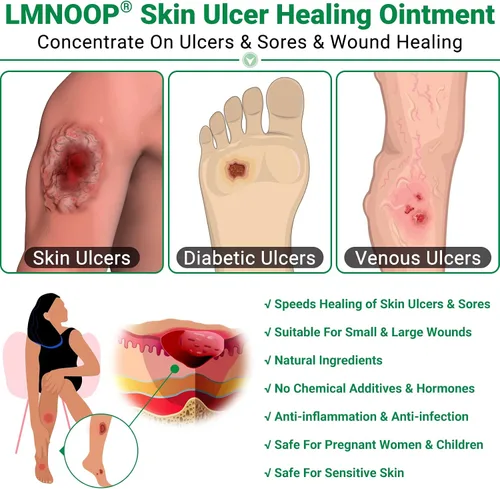 Vista 3 de Ungüento curativo de úlceras cutáneas, para úlceras de pies y piernas, llagas, úlceras varicosas, úlceras por estasis, úlceras por decúbito, cortes