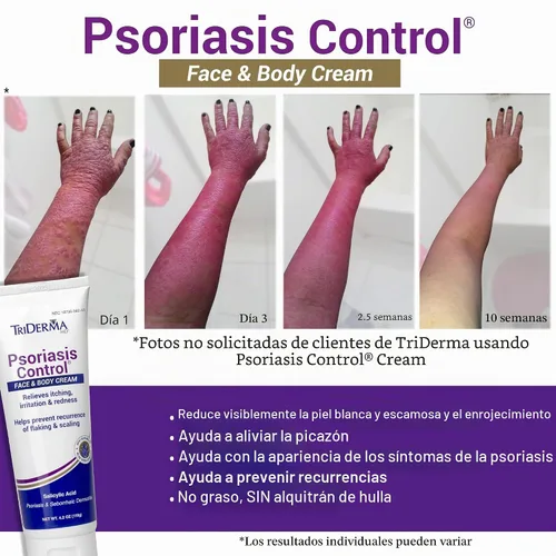 Vista 3 de TriDerma Crema facial y corporal para control de la psoriasis, 4.2 onzas