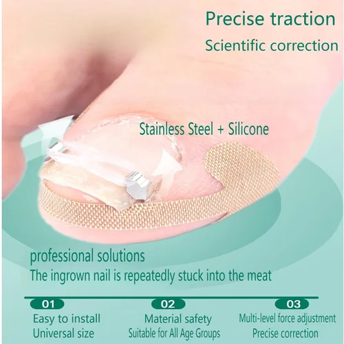 Vista 3 de Kit corrector de uñas encarnadas para hombres y mujeres, herramienta de uñas encarnadas, 2 clips de acero inoxidable, tiras de uñas curvas