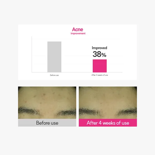 Vista 7 de ROVECTIN Crema limpiadora de manchas Cica Care: alivia la irritación de la piel y mejora la grasa, sebo, puntos negros para pieles grasas