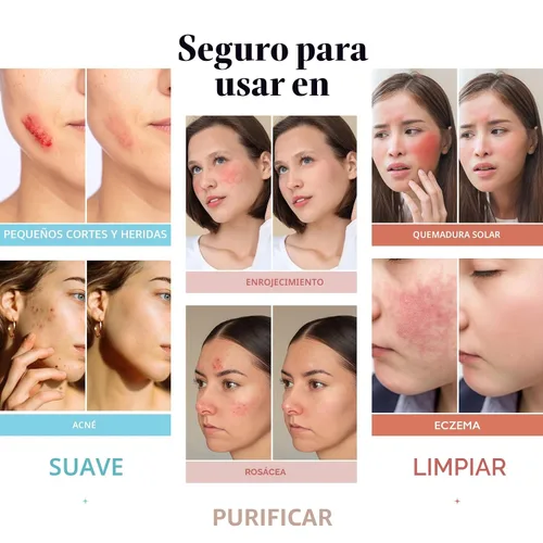 Vista 5 de Spray de ácido hipocloroso para cara y piel; limpiador facial 32 onzas de repuesto de spray de ácido hipocloroso para piel, acné, erupción