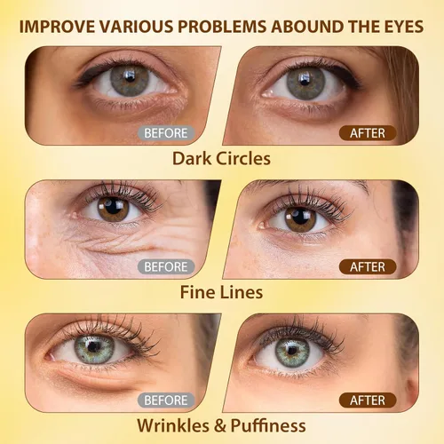 Vista 7 de Suero para ojos con 5% de cafeína, retinol, niacinamida y ácido hialurónico, bálsamos oculares con tratamiento antienvejecimiento para ojeras
