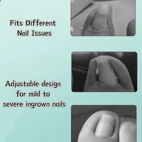 Vista 9 de Kit corrector de uñas encarnadas para hombres y mujeres, herramienta de uñas encarnadas, 2 clips de acero inoxidable, tiras de uñas curvas
