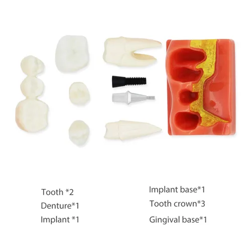 Vista 3 de Modelo de dientes dentales D-IP, modelo de dientes de implante dental transparente Dentista Enfermedad estándar Diente extraíble Modelo de enseñanza