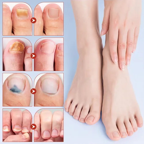 Vista 6 de Uñas extra fuertes – Parches nocturnos para uñas de pies reparación y cuidado (21 unidades)