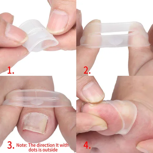 Vista 5 de Corrector de uñas encarnadas, 2 piezas de herramienta de corrección de uñas encarnadas de silicona, corrector de uñas encarnadas, tratamiento
