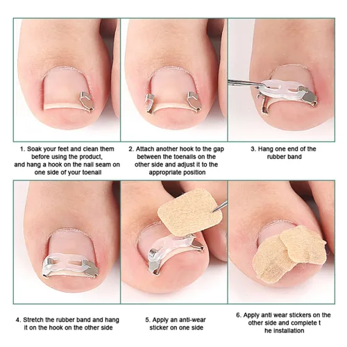 Vista 5 de Juego de herramientas de corrección de uñas encarnadas, 2 clips de inserción de acero inoxidable para tratamiento de uñas encarnadas, tiras