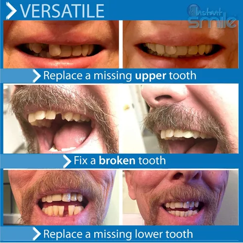 Vista 4 de Instant Smile Kit de dientes temporales -Pro-Series