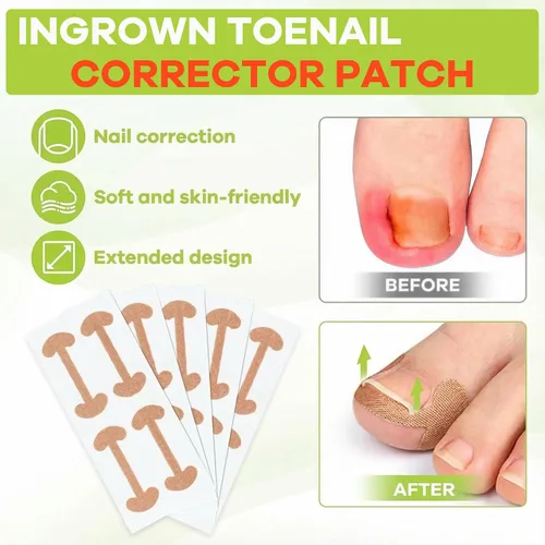 Vista 3 de Kit corrector de uñas encarnadas, herramientas de uñas, tiras de corrección transpirables con herramientas de levantamiento de uñas, cortaúñas