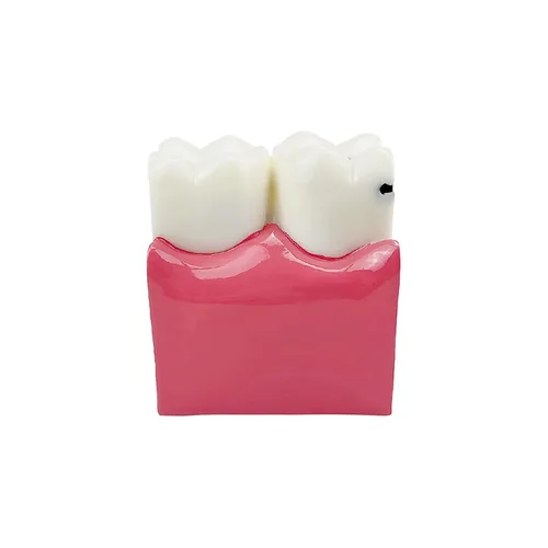 Vista 9 de Modelo de dientes de caries dental, modelo YOUYA DENTAL 6 veces de dientes de caries modelo de anatomía dental para educación de dientes